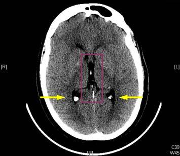 Our patient: Axial C Head CT Foci of increased attenuation in the occipital horns of the lateral ventricles consistent with