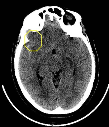 Our Patient: Axial C Head CT (con t) Continuing caudally down this axial CT at the level of the frontal sinus Hyperdense layering is