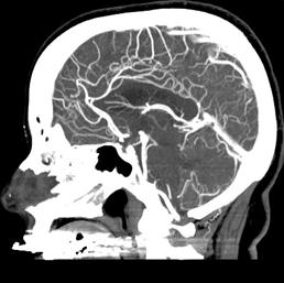 CTA Involves obtaining a normal CT of the head while IV contrast material is injected into a peripheral vein.