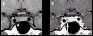 Dynamic imaging of microadenomas Companion patient 2: Advantage of dynamic MRI in imaging microadenomas A small area of low signal intensity within the pituitary gland prior to contrast