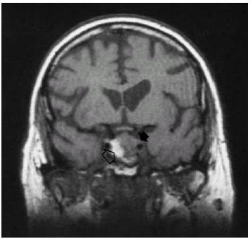 Pituitary apoplexy: a sequela of macroadenoma Companion patient 3: MRI image Acute onset of neurologic symptoms caused by tumor hemorrhage and expansion of gland Occurs in 3-26% 3 of macroadenomas T1