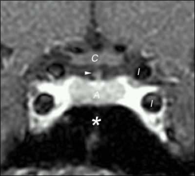 Carotid Artery *: Sphenoid Sinus Arrowhead: Pituitary Stalk www.neurosurgery.medsch.ucla.