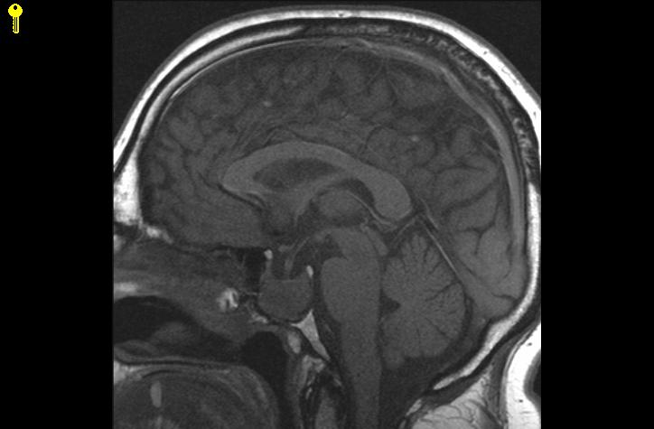 Patient 1 images MRI of the pituitary gland