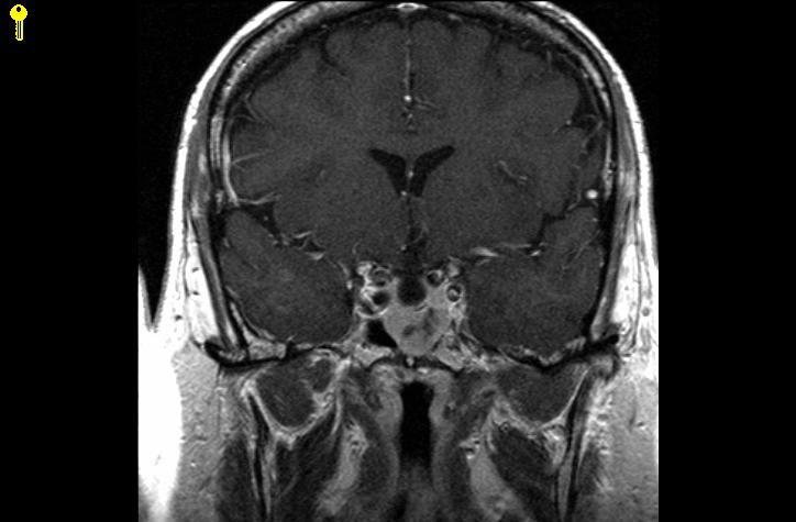 Patient 1 images MRI of the pituitary gland Precontrast coronal T1 image