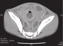(C) and (D) CT of the abdomen reveals multiloculated abscesses in the pelvic cavity (black arrow). cal condition could present symptoms and signs mimicking acute abdomen.