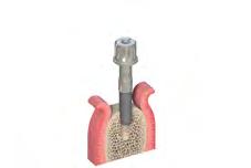 If 35 Ncm are achieved before the implant has reached its final position, make sure the implant-bed preparation is correct to avoid bone overcompression. Warning!