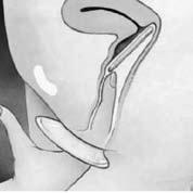 Pinch the inner ring (at the closed end of the condom) with your thumb and middle finger so that it becomes long and narrow in order for you to insert it, a bit like one does with a diaphragm.