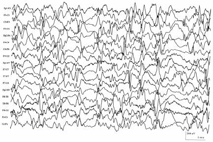 Hypsarrhythmia - classic interictal EEG pattern Disorganized background High voltage (>300 µv) slowing Frequent