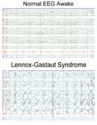 Lennox-Gastaut Syndrome Onset between 2-8 yrs, often before 5 yrs Etiology 30% cryptogenic, 70% symptomatic Up to 1/3 of cases occur in previously normal children Cerebral malformations, HIE,