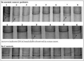 Figure 2: Single stranded conformational polymorphism studies of exon 3 of Erythropoietin gene. (Bands in lanes indicate denatured Exon3 PCR products, ran on polyacrylamide gels.