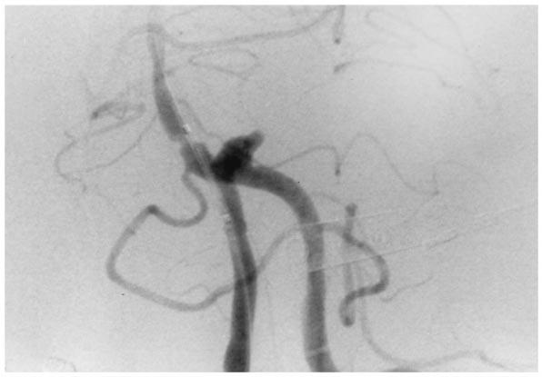 292 Surg Neurol Horowitz et al 1 Vertebral confluence aneurysm before treatment. (Hunt Hess III) with mild limitation of lateral gaze bilaterally but intact vertical gaze.