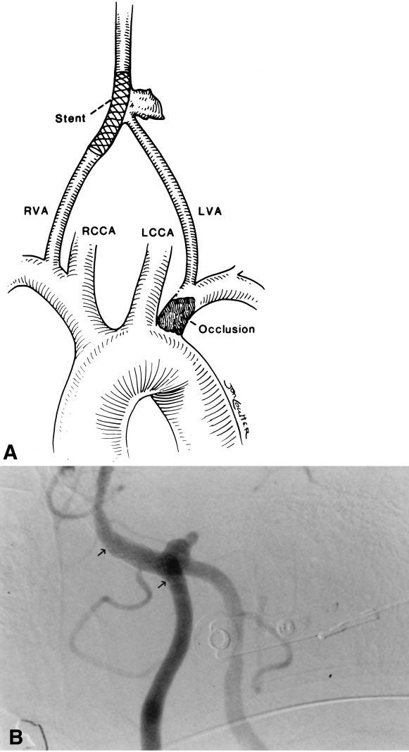 Vertebrobasilar Aneurysm Stent-Assisted Embolization Surg Neurol 293 (A) Diagram showing position of the stent across the 2 aneurysm s neck before coil deposition.