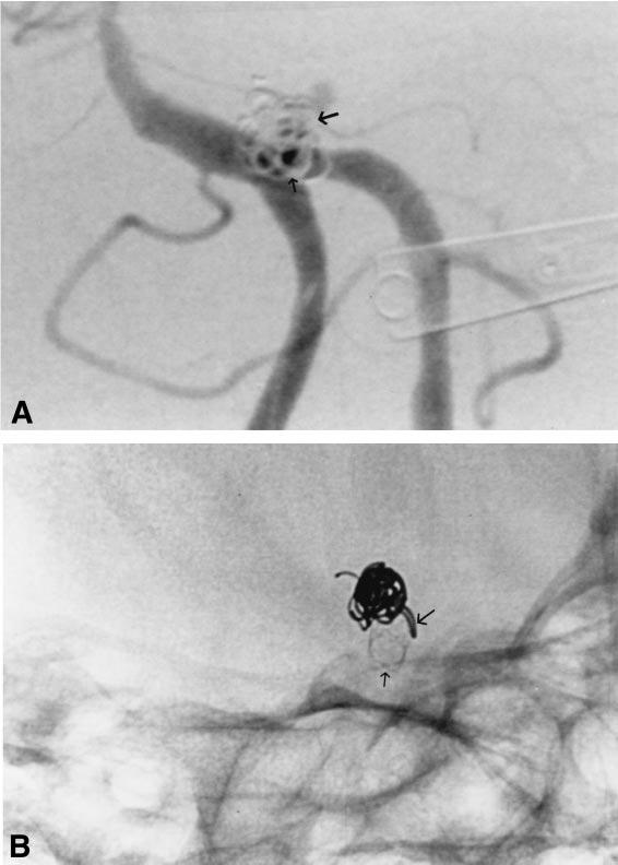294 Surg Neurol Horowitz et al Oblique view (A) of the aneurysm following initial 3 coiling. One of the apical blebs continues to opacify, as does a small portion of the fundus (large arrow).