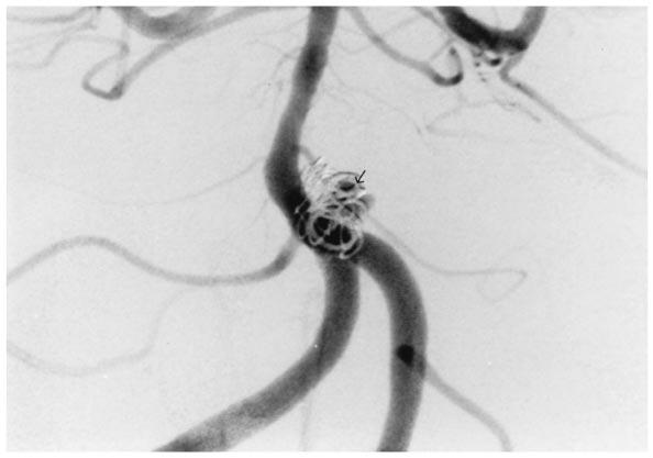 Vertebrobasilar Aneurysm Stent-Assisted Embolization Surg Neurol 295 Fundal filling (small arrow) 5 after aspirin, heparin, and Plavix therapy. The basilar thrombus is no longer present.