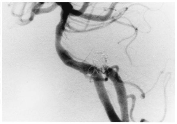Of these 10 patients, one patient had an intracranial vertebral artery aneurysm and three others had basilar artery aneurysms. The remaining patients had internal carotid artery aneurysms [6].