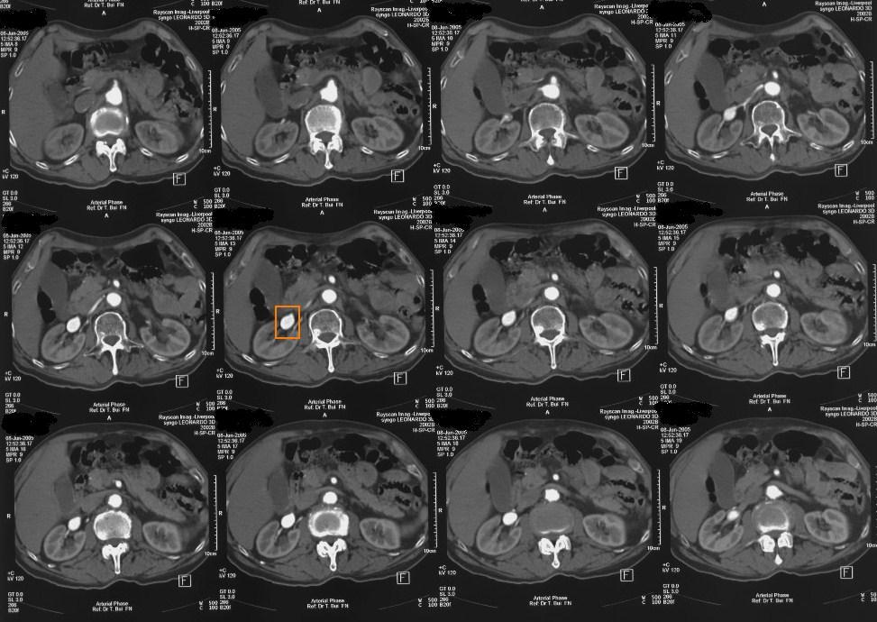 FIGURES Figure 1: Axial images of contrast computed tomography of a 77-year-old male with hypertension