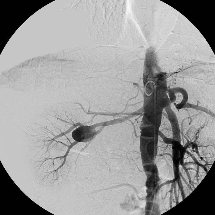Figure 4: Abdominal angiogram of a 77-year-old male with hypertension showing an oval aneurysm measuring
