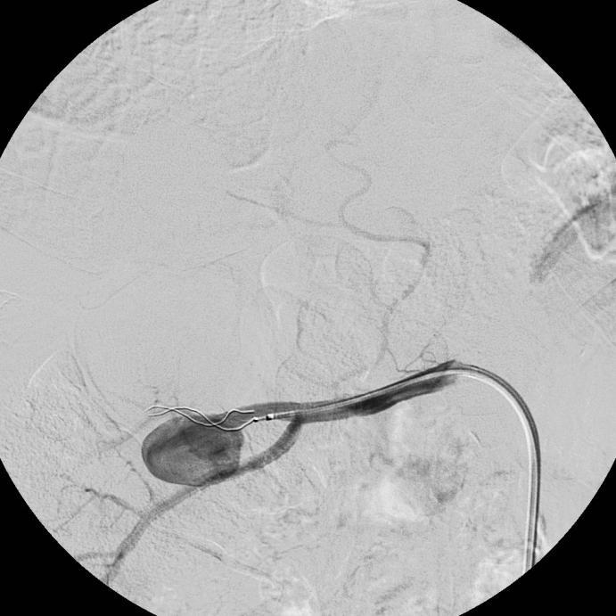5cm in maximum diameter arising from the upper first divisional vessel of the right renal artery.