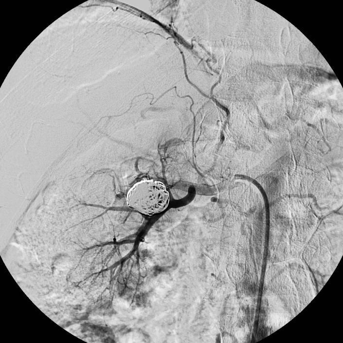 CT: computed tomography RAA: renal artery aneurysm ABBREVIATIONS KEYWORDS Renal artery aneurysm; stent; coil embolization Figure 6: Renal angiography of a 77-year-old male with hypertension showing