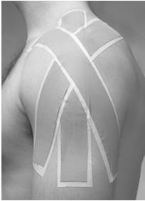 SHOULDER STABILITY TAPING Patient position: Sitting in neutral with arm