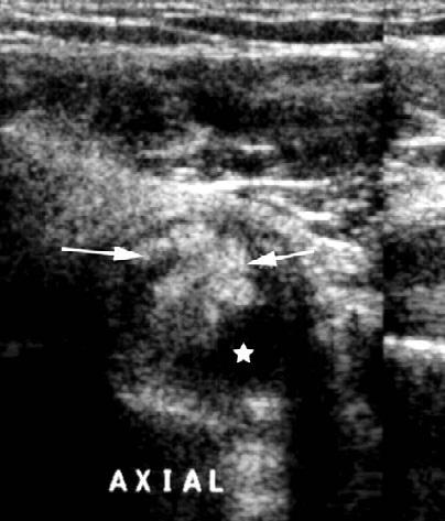 A. Bargiela, E. Rodriguez, R. Soler synovial fatty proliferation have been described based on MRI findings [2].