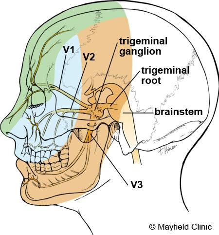 Although the exact cause of trigeminal neuralgia is not fully understood, a blood vessel is often found compressing the nerve.