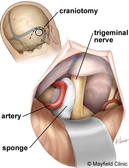 Surgery The goal of surgery is to stop the blood vessel from compressing the trigeminal nerve, or to cut the nerve to keep it from sending pain signals to the brain.
