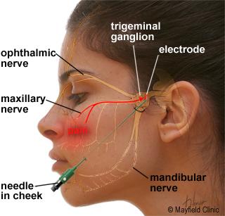 Radiofrequency rhizotomy, also called Percutaneous Stereotactic Radiofrequency Rhizotomy (PSR), uses a heating current to selectively destroy some of the trigeminal nerve fibers that produce pain.