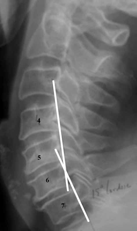 ANTERIOR CERVICAL INTERBODY FUSION WITH RADIOLUCENT CARBON FIBER CAGES 607 was observed in 5 out of 6 cages (83%) at the C4- C5 level, in 21 out of 24 cages (88%) at the C5-C6 level and in 12 out of