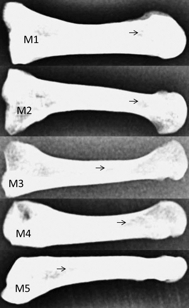 metatarsal, arrow mark showing the single foramen; M4: fourth metatarsal, arrow marks showing the double foramina; M5: fifth metatarsal bone, arrows mark showing the single nutrient foramen).
