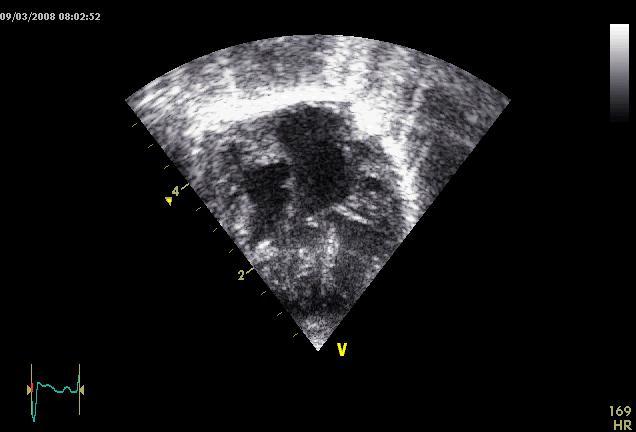 Inlet ventricular septal defect Apical 4