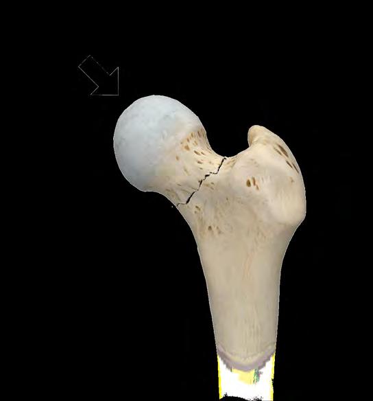 femoral neck fracture.