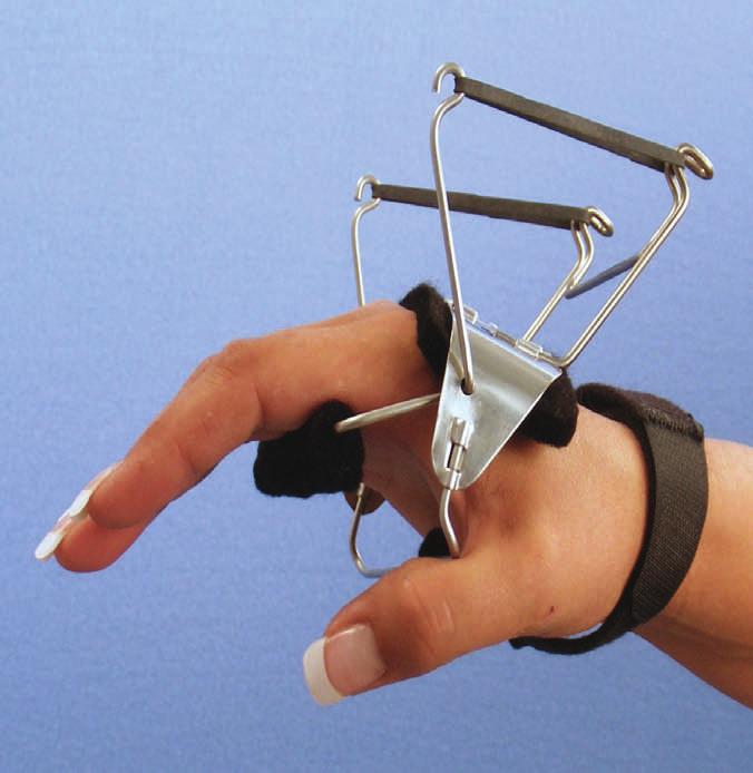 #2 Knuckle Bender Splint to flex the metacarpophalangeal joints.