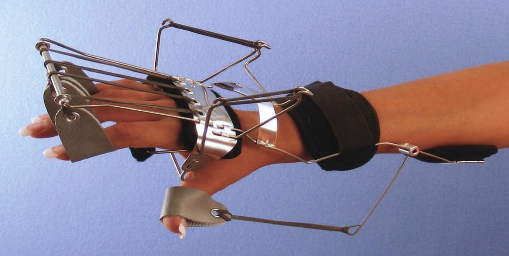 Sizes: SM, MD, #13B Combination of Coiled Spring Wire Oppenheimer to dorsiflex the wrist with Composite Elastic Splint to extend the M.P. and P.