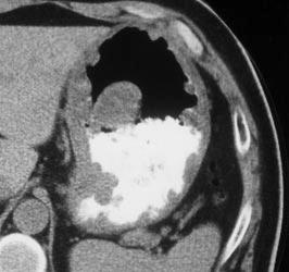 [5] described the radiologic appearance in a series of eight gastric carcinoid tumors, seven of which were solitary tumors.