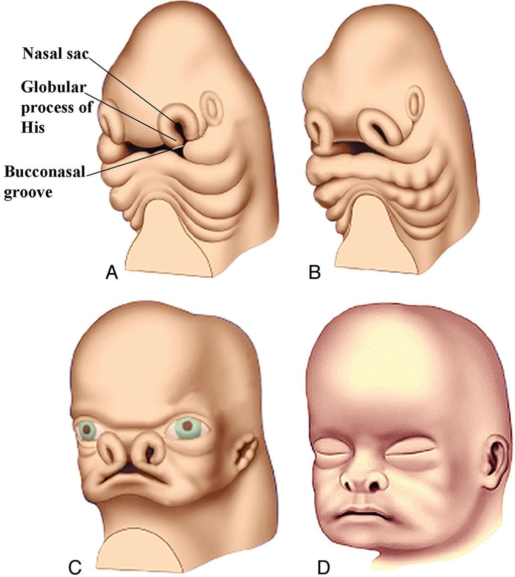 Normal facial development if embryo cells don t migrate and differentiate normally, midline facial features (eye spacing,