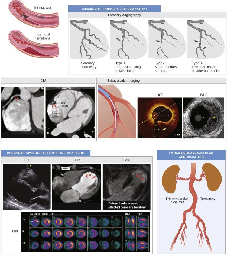 Imaging for SCAD Coronary Angiography OCT IVUS Echo CCTA CMR Stress