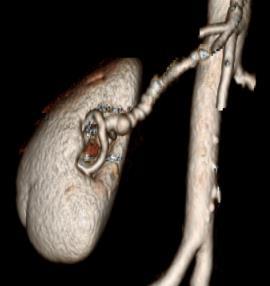 SCAD and Vascular Abnormalities on CT 115 Mayo Clinic SCAD outpatients Overall Vascular Abnormalities 66% Vascular abnormalities: Overall
