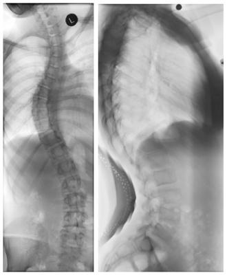 Understanding Scoliosis 6 If a curve is discovered during screening, radiographs may be ordered.