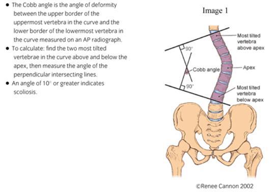 5) Radiographs of the entire spine help to determine the presence of scoliosis and the degree of curve by evaluation of the Cobb angle (Larson, 2011, p. 395).