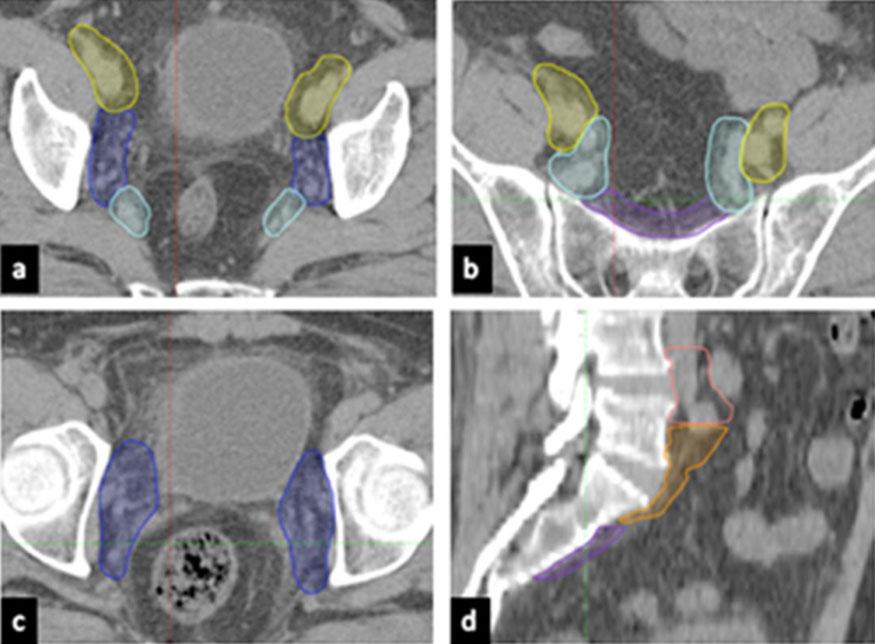 384 Technology in Cancer Research & Treatment 16(3) Figure 1. Planning computed tomography (CT) images in axial view showing the pelvic nodal regions (a-d).