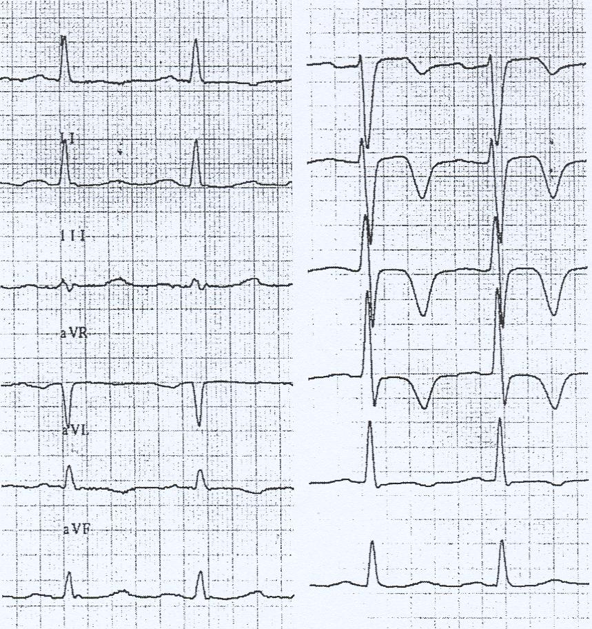 In the next figure we will see an example of this pattern. A: ECG at basal state without pain.