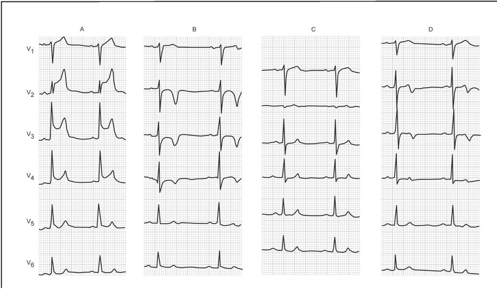 The next figure shows the ECG evolution of a patient who presents STE- ACS (A) During pain with ST elevation, (B) after PCI with negative T waves (reperfusion pattern), (C) Six hours after the PCI