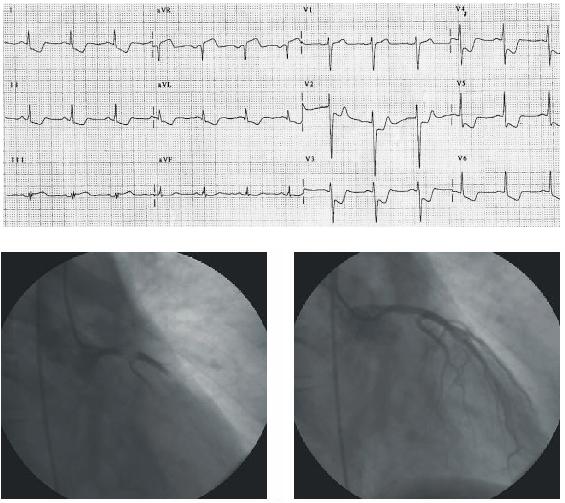 Another example of extensive ischemia due to Left main trunk (LMT) in wich we can see ST
