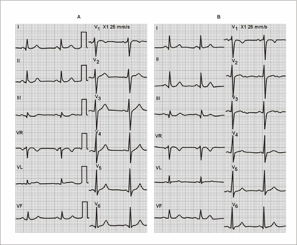 In A: ECG of a patient taken 6 months before. In B: Patient with previous chest pain 3 days ago and now, without pain.