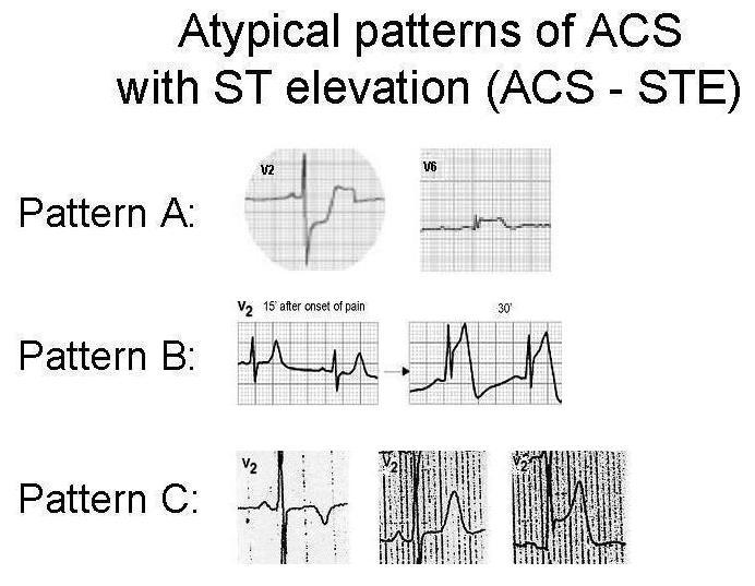The STE-ACS may present other ECG patterns than ST