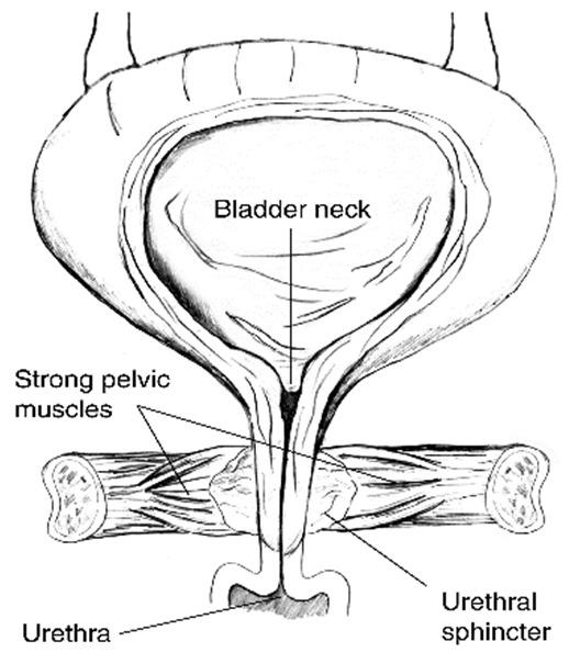 exercise, straining, coughing, laughing, or sneezing. This type of incontinence usually occurs in women, especially those who have had multiple vaginal deliveries or pelvic surgery.
