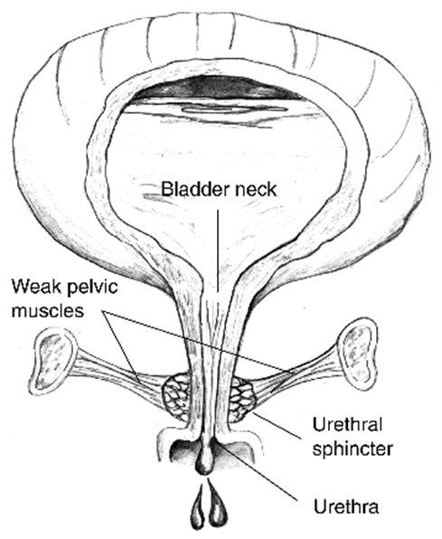Decreased outlet resistance may result from any process that damages the innervation or structural elements of the smooth and/or striated sphincter or support of the bladder outlet in the female.