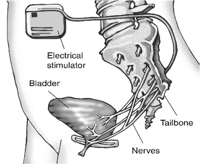 Neuromodulation Sacral nerve stimulation (SNS) Stimulation of the sacral nerve roots is a technique in which an electrical stimulus directly stimulates the S3 sacral nerve root.