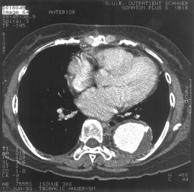 Patients with a thoracoabdominal aortic aneurysm may have a palpable pulsatile mass in the upper abdomen.